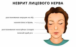 Неврит